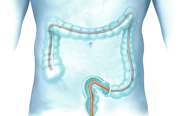 Mag och tarm - Koloskopi