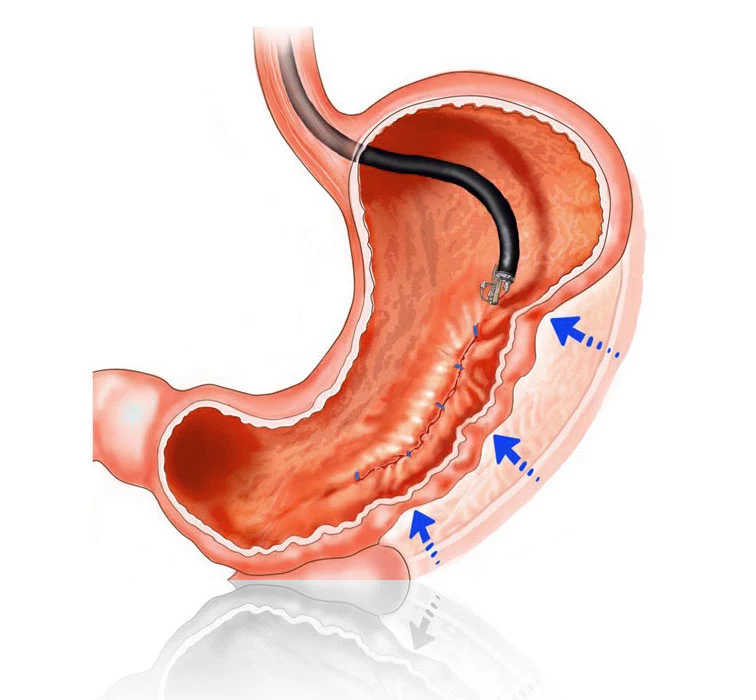 Endoskopisk sleeve, operation