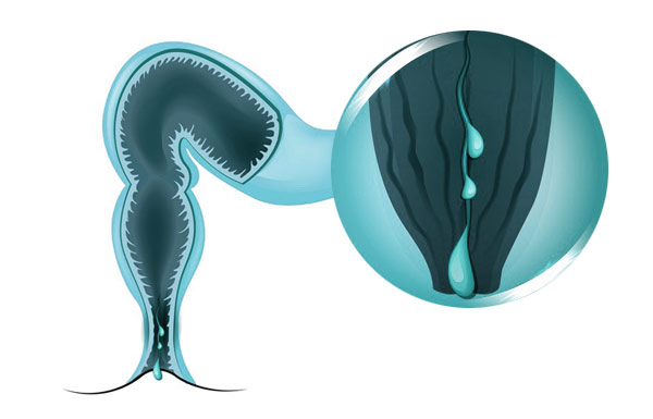Analfissur
